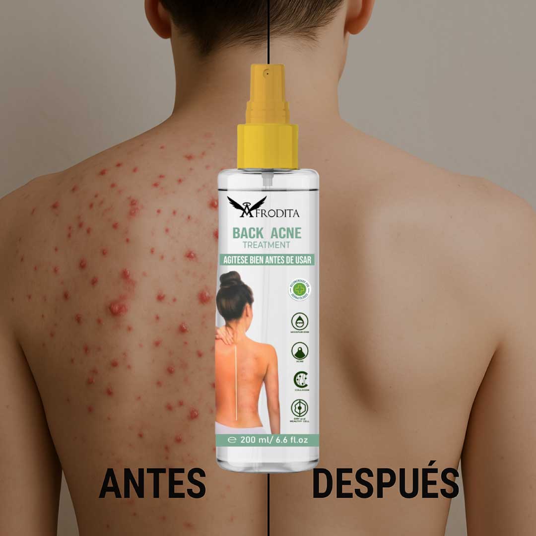 Elimina el acné en tu espalda sin cremas incómodas ni ayuda
